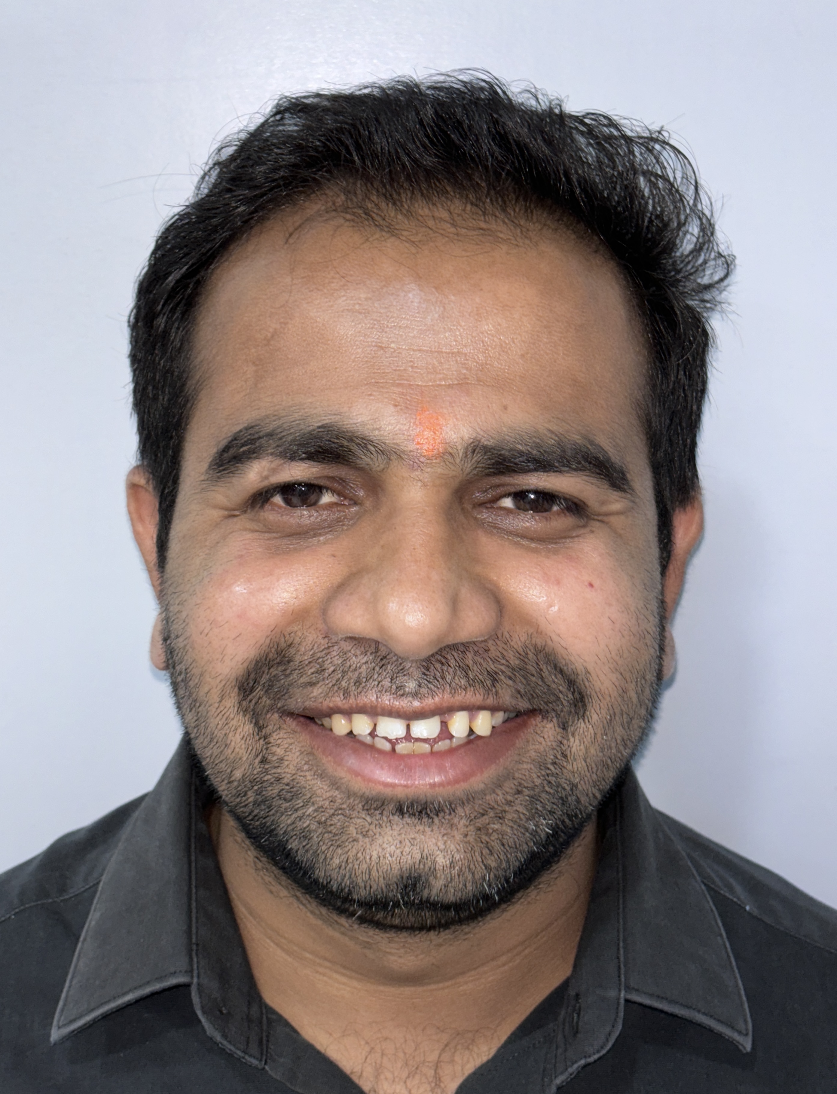 Case of Open Bite & Spacing - Before Invisalign Aligner Treatment